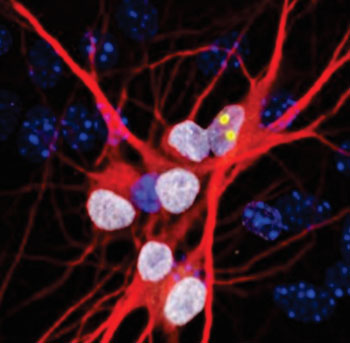 Image: Neurons (red) created from ALS patients bearing the C9orf72 mutation show clumps of the RanGAP protein (yellow) in their nuclei (white). The nuclei of other cells are in shown in blue (Photo Jeffrey Rothstein laboratory, Johns Hopkins University).
