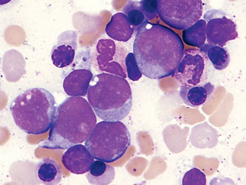 Image: Bone marrow aspirate smear showing blasts with high nuclear: cytoplasmic ratio from a patient with acute myeloid leukemia (Photo courtesy of the Cleveland Clinic).
