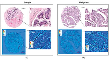 Image: A comparison of stained bright-field microscopy (top row) and SLIM (bottom row) images in their respective abilities to show malignant and benign. The images were obtained from adjacent sections. Color bars are in radians (Photo courtesy of Hassaan Majeed).