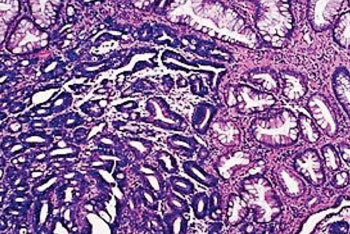 Image: Histopathology of advanced gastric carcinoma of the intestinal type shows gland-forming adenocarcinoma and adjacent intestinal metaplasia (Photo courtesy of Drs. Shabnam Bashir and Sudip Raina).