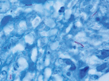 Image: Mycobacterium tuberculosis (stained purple) in a tissue specimen (blue) (Photo courtesy of the CDC – [US] Centers for Disease Control and Prevention).