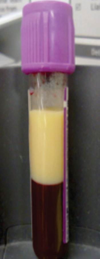 Image: A four milliliter sample of hyperlipidemic blood with lipids separated into the top fraction (Photo courtesy of Wikimedia Commons).
