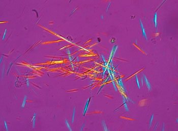 Image: Spiked rods of uric acid crystals from a synovial fluid sample photographed under a microscope with polarized light (Photo courtesy of Bobjgalindo).