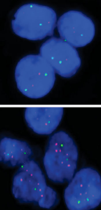 Image: Top, breast cancer tumor cells negative for the bone metastasis marker, MFA. Bottom, breast cancer tumor cells positive for the marker (Photo courtesy of Gomis Laboratory, Institute for Research in Biomedicine, Barcelona).