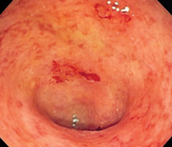 Image: Endoscopic image of a bowel section known as the sigmoid colon afflicted with ulcerative colitis. The internal surface of the colon is blotchy and broken in places (Photo courtesy of Wikimedia Commons).