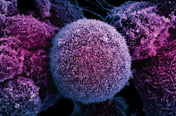 Image: Scanning electron micrograph of human prostate cancer cells (Photo courtesy of University of Sheffield).