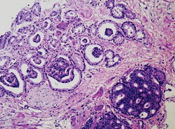 Image: Histopathology of prostate cancer; glomerulations demonstrating significant morphologic overlap with and transition to cribriform Gleason pattern 4 carcinoma (Photo courtesy of Memorial Sloan-Kettering Cancer Center).