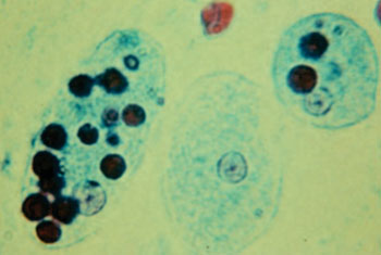 Image: Trophozoites of Entamoeba histolytica with ingested erythrocytes that appear as dark inclusions in this trichrome stained slide (Photo courtesy of the CDC - [US] Centers for Disease Control and Prevention).