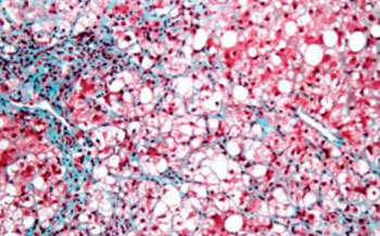 Image: Micrograph of an inflamed fatty liver. White indicates areas of fat; red are hepatocytes or liver cells. Bluish areas are fibrotic strands (Photo courtesy of Dr. James Heilman).