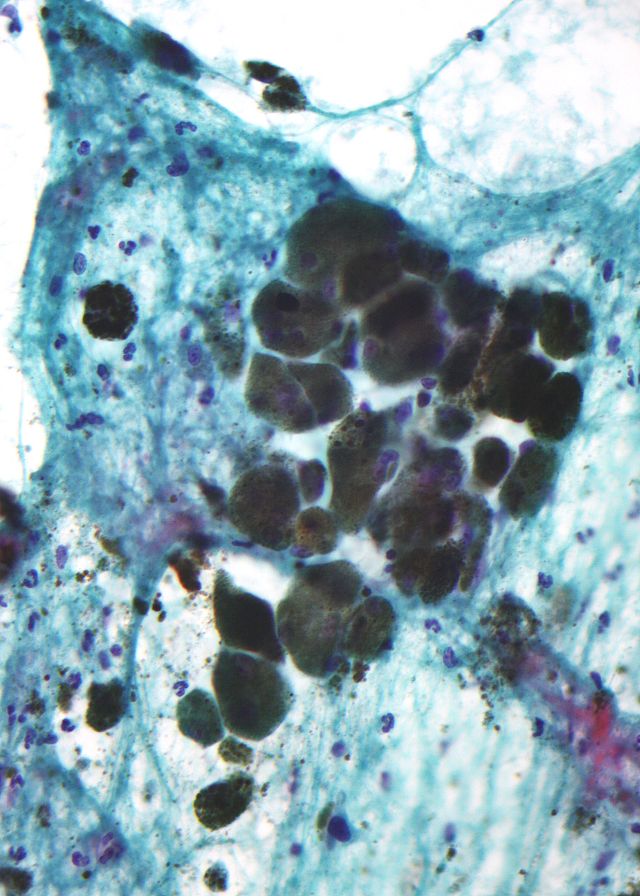 Image: Melanin pigment (light refracting granular material – center of image) in a pigmented melanoma (Photo courtesy of Wikimedia Commons).