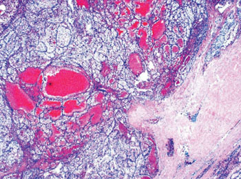Image: Histopathology of metastatic renal cell carcinoma (Photo courtesy of Dr. Mark R. Wick).