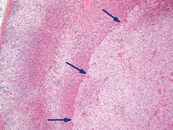 Image: Histopathology of an adrenal incidentaloma showing the pushing border between the adenoma and the surrounding parenchyma (arrows) (Photo courtesy of the Government of Western Australia).