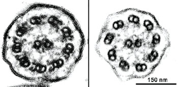 Image: Ciliary ultrastructure on the right from a patient with primary ciliary dyskinesia (PCD) showing the absence of outer and inner dynein arms and on the left normal cilium from a healthy individual in which both inner and outer dynein arms can clearly identified (Photo courtesy of Dr. J. Carson, PhD).