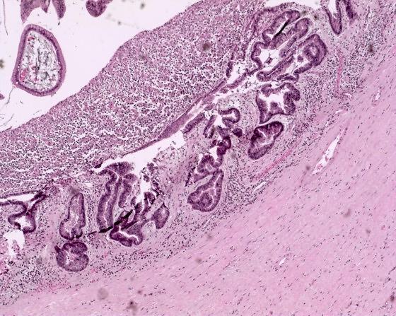 Image: Histopathology of pancreatic cancer showing a main-duct type intraductal papillary mucinous neoplasm (IPMN) with a focus of high-grade dysplasia compatible with malignant IPMN with carcinoma-in-situ (Photo courtesy of National Cancer Center. Singapore).