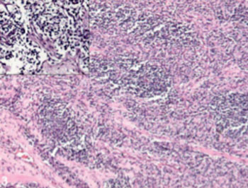 Image: Photomicrograph of alveolar rhabdomyosarcoma showing nodules of tumor cells separated by hyalinized fibrous septae (50x, HE stain). Inset: Discohesive large tumor cells with hyperchromatic nucleus and scant cytoplasm (200x, HE stain) (Photo courtesy of Wikimedia Commons).