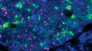 Image: The image above demonstrates results obtained by an investigational four-plex diagnostic test (i.e., one that can detect up to four different, cancer-promoting, genetic defects in one tissue sample at the same time). Positive identification of the biomarkers in this lung tumor biopsy is indicated by pink, light blue, and green staining (normal tissue is unstained, i.e., dark blue) (Photo courtesy of Roche).