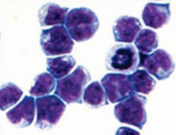 Image: Photomicrograph of cancerous mouse bone marrow cells generated by the mutant protein AE, found in about 15% percent of acute myeloid leukemia patients (Photo courtesy of the Laboratory of biochemistry and molecular biology at the Rockefeller University).