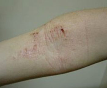 Image: Atopic dermatitis of the inside crease of the elbow (Photo courtesy of Wikimedia Commons).