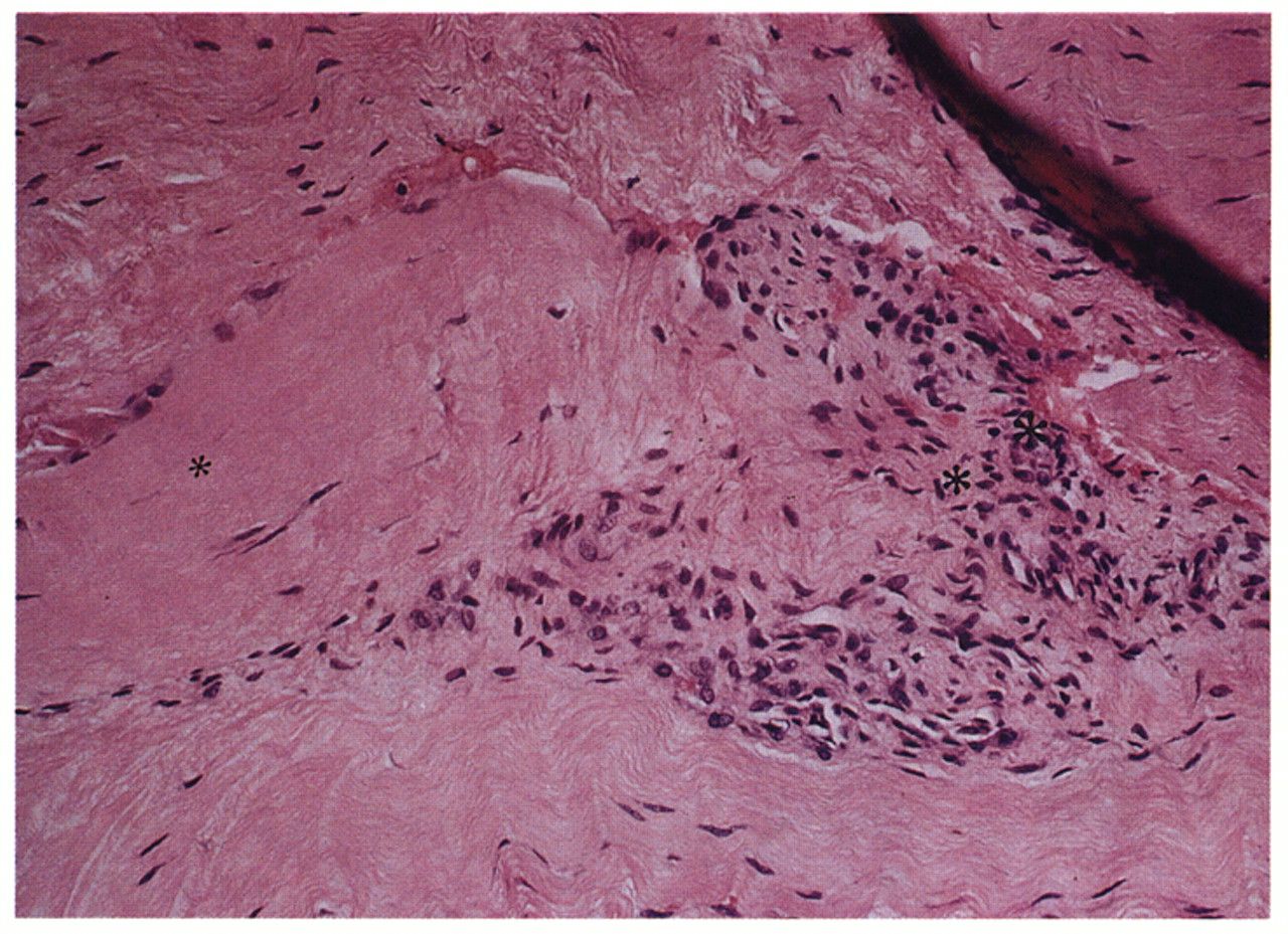 Image: Histologic appearance of tendinosis tissue shows a characteristic pattern of fibroblasts and vascular, atypical, granulation-like tissue (Photo courtesy of Dr. Barry S. Kraushaar, MD).