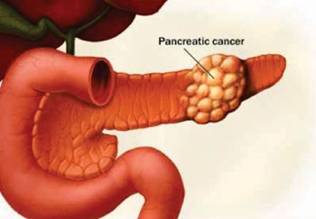 Image: Historically, only about 7% of pancreatic cancer patients have lived at least 5 years after diagnosis. The widely available blood test for tumor marker CA 19-9 is among the advancements that are improving the odds, a new study recommends (Photo courtesy of Mayo Clinic).