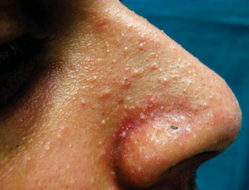 Image: Mucocutaneous papilloma manifestations around the nose of an autosomal dominant condition known as Cowden syndrome (Photo courtesy of University of Sao Paulo).