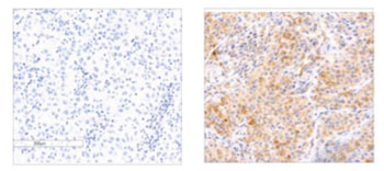 Image: Metastatic melanoma tumors. The micrograph on the left shows low or absent expression of RASA2, which is linked to reduced survival of about 35% of patients. The sample on the right exhibits high RASA2 expression and increased survival (Photo courtesy of the Weizmann Institute of Science).