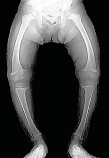 Image: Radiograph of a child suffering a deficiency of vitamin D and has manifested symptoms of the disease Nutritional Rickets (Photo courtesy of Dr. Michael L. Richardson, MD).