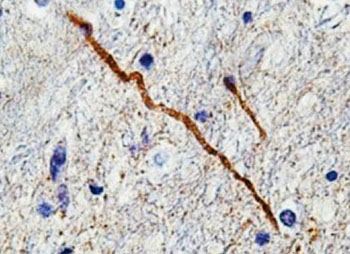 Image: SNTF stained axons (brown) shortly after traumatic brain injury. The undulating course suggests damage to the internal skeleton, and the SNTF stain shows the high calcium concentration-activated enzymes that destroy the axon from the inside out (Photo courtesy of the laboratory of Douglas Smith, MD).