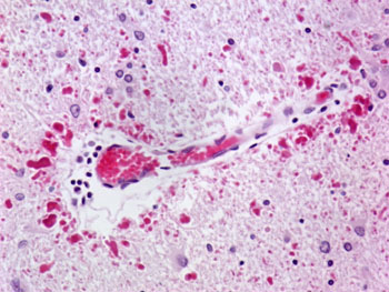 Image: Standard histology H&E (hematoxylin and eosin) staining of tissue from an eight-year-old Alexander disease patient. Rosenthal fibers—the hallmark of the disease—are shown in pink; nuclei are shown in blue (Photo courtesy of Liqun Wang, Feany Laboratory, Brigham and Women\'s Hospital).
