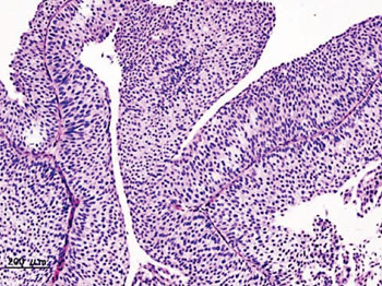 Image: Histopathology of urothelial carcinoma of the urinary bladder from a transurethral biopsy (Photo courtesy of KGH/Wikipedia).