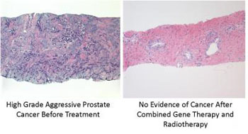Image: The image on the left shows high-grade aggressive prostate cancer before treatment. The image on the right shows no evidence of cancer after combined gene therapy and radiotherapy (Photo courtesy of the Houston Methodist Hospital).