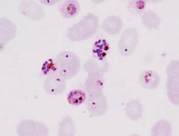Image: Photomicrograph of a peripheral blood smear showing schizonts and trophozoite stages of Plasmodium falciparum (Photo courtesy of Chiang Mai University).