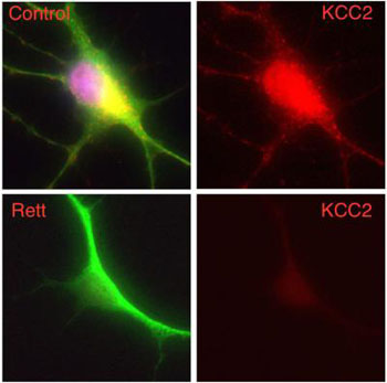 Image: A human nerve cell derived from a patient with Rett syndrome shows significantly decreased levels of KCC2 compared to a control cell (Photo courtesy of Gong Chen laboratory, Pennsylvania State University).