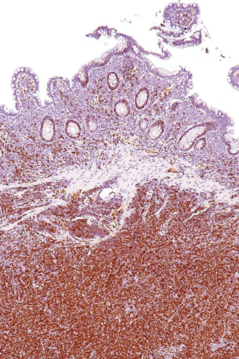 Image: Micrograph of cyclin D1 staining in a mantle cell lymphoma (Photo courtesy of Wikimedia Commons).