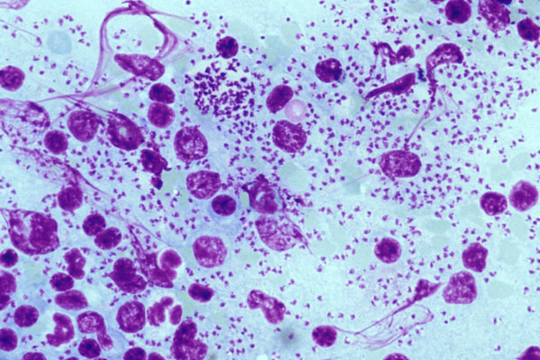 Мазок-отпечаток пациента, зараженного Leishmania infantum, демонстрирующий многочисленные тельца представителей простейших, фагоцитируемые макрофагами (фото любезно предоставлено доктором Ютака Тсуцуми (Yutaka Tsutsumi)).