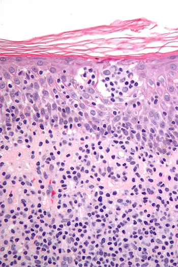 Image: Very high magnification micrograph of cutaneous T-cell lymphoma (Photo courtesy of Wikimedia Commons).
