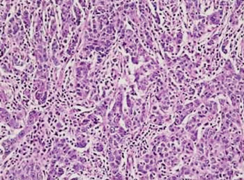 Image: Histopathology of a left-ovarian mass showing a histologic picture similar to the breast carcinoma with sheets of high-grade tumor cells surrounded by a lymphoplasmacytic infiltrate. The patient had a BRAC2 gene mutation (Photo courtesy of NYU Langone School of Medicine).