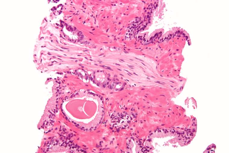 Микрофотоснимок аденокарциномы предстательной железы с периневральной инвазией,  типичная (ацинарная) форма, наиболее распространенная форма рака предстательной железы (фото любезно предоставлено компанией Nephron и ресурсом Wikimedia).