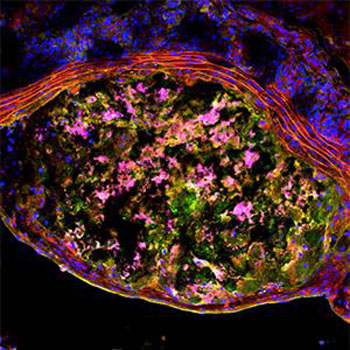 Image: Cross-section of a mouse aorta with a large plaque. Red lines near the top of the cross-section are the wall of the aorta. The plaque contains a dysfunctional buildup of immune macrophages (pink) and protein waste (green) (Photo courtesy of Dr. I. Sergin, Washington University School of Medicine).