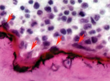 Image: Cross-section of a mouse femur. The white and purple cells are bone marrow, the pink area is bone, and the arrows show osteoclasts resorbing bone. This mouse has too many osteoclasts; it has a variant of the NOTCH2 gene that causes a disease akin to Hajdu-Cheney syndrome in humans (Photo courtesy of Stefano Zanotti/Canalis Laboratory, University of Connecticut).