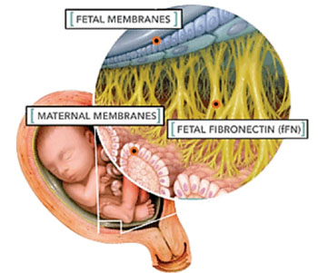 Image: Fetal fibronectin is a “glue-like” protein that holds the developing baby in the womb (Photo courtesy of Hologic Inc.).