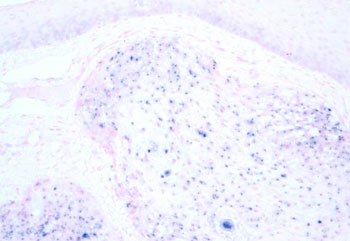 Image: Human papillomavirus (HPV)-positive head and neck squamous cell carcinoma (HNSCC) identified by in situ hybridization (Photo courtesy of Jennifer L. Hunt, MD, and Wikimedia).