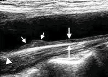 Image: Carotid Intima-Media Thickness (CIMT) ultrasound exam showing a carotid artery with a wall that is much thicker than normal and mild plaque formation (Photo courtesy of Preventive Cardiology Consultants).