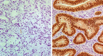 Image: Patients whose stage II colon cancer tested negative for CDX2 expression (left) had a worse prognosis than those whose cancer tested positive (right) (Photo courtesy of Columbia University Medical Center).