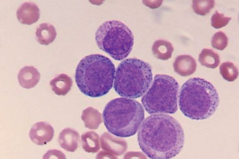 Image: Peripheral blood smear of a patient with acute myeloid leukemia (Photo courtesy of Dr. Abbas H. Abdulsalam).