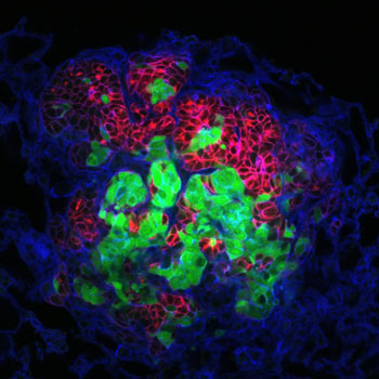 Image: A metastasis now growing in lung tissue (blue) that originated from at least two cells (red and green) from a multicolored tumor in the mammary gland of a mouse (Photo courtesy of Breanna Moore, Cheung laboratory, Fred Hutchinson Cancer Research Center).