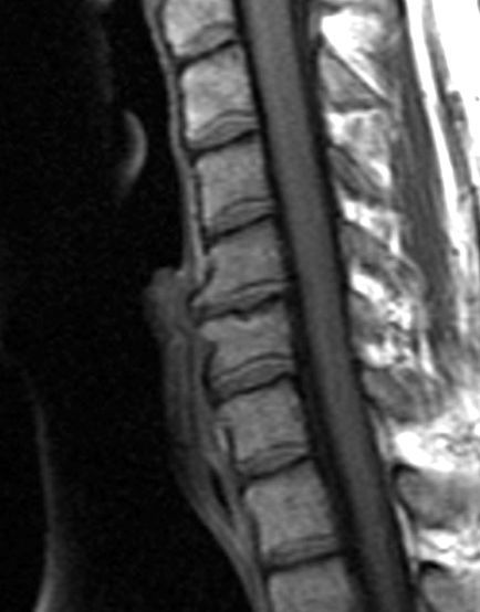 Саггитальный срез на снимке МРТ шейного отдела позвоночника, Т1-взвешенное изображение, демонстрирующий дегенеративное заболевание межпозвонковых дисков, остеофиты и остеоартрит C5-C6 (изображение любезно предоставлено ресурсом Викимедиа).