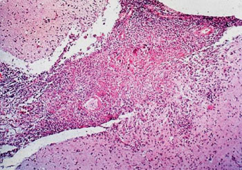 Image: Histopathology of tuberculous meningitis showing a necrotic lesion of the subarachnoid space with superficial invasion of the brain (Photo courtesy of Dr. D.P. Agamanolis, MD).