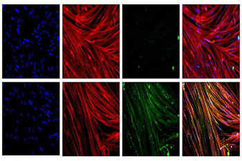 Image: Top row: skeletal muscle without dystrophin. Left to right: skeletal muscle nuclei (blue), skeletal muscle (red), missing dystrophin, overlay of all three images to the left. Bottom row: skeletal muscle with restored dystrophin after application of the CRISPR/Cas9 platform. Left to right: skeletal muscle nuclei (blue), skeletal muscle (red), dystrophin (green), Overlay of all three images to the left. Dystrophin appears yellow in overlay image (Photo courtesy of University of California, Los Angeles).