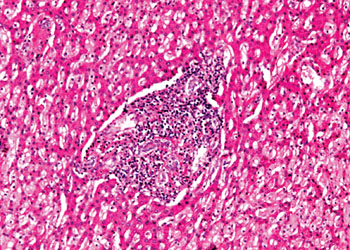 Image: Histopathology of metastatic carcinoma in liver tissue from a patient with colorectal cancer (Photo courtesy of Nikon).